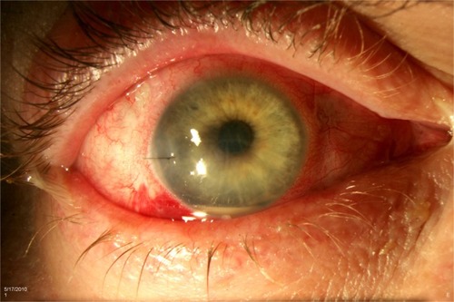 Figure 1 Acute-onset postoperative endophthalmitis (note the sutured corneal wound and hypopyon).