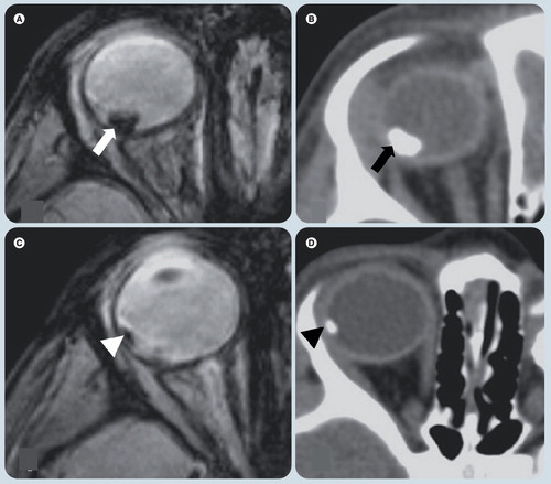 Figure 3. A case of right orbital retinoblastoma.(A & C) Axial gradient echo T2* weighted images show dark signal intensity of ocular calcification corresponding with (B & D) hyperattenuated calcified spots on CT scans in the same patient.Reprinted with permission from Citation[7].