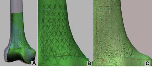 Figure 5 Evaluate the navigation accuracy: (A) post-operative surface scanned image is first aligned with reference CT-scan model. After that, the osteotomy lines drawn by a surgeon is compared with the reference CT-scan model in coronal view to assess the navigation accuracy. (B) The result of the 3D-LAD method: the osteotomy lines drawn by a surgeon is in red color (with “X” grid as a visual aid), to compare with the cyan line segments; (C) the result of traditional manual method: the osteotomy lines drawn by a surgeon is in red color, to compare with the cyan line segments.