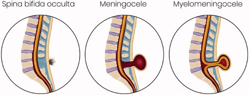 Figure 13. Emily Wallace – Types of Spina bifida – This set of illustrations show the anatomical variations of spina bifida occulta, meningocele and myelomeningocele.