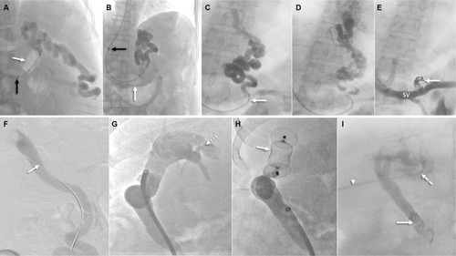 Figure 3 Interventional management of portosystemic shunt syndrome.