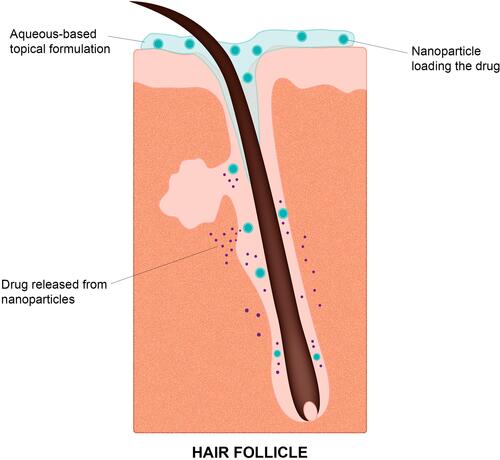 Figure 2 Scheme of the proposed mechanism for targeted drug delivery to the hair follicles provided by topical application of a nanoparticulate formulation.
