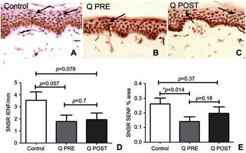 Figure 4 Immunohistochemistry in skin biopsies for SNSR, before and after capsaicin 8% patch treatment. Intra-epidermal nerve fibers (arrowed) and sub-epidermal nerve fibers from (A) control subjects, at the baseline visit (B, Q PRE) and, after capsaicin 8% patch treatment (C, Q POST), magnification x40. (D) Bar chart of intra-epidermal nerve fibers for SNSR (IENF) counts; (E) bar chart of sub-epidermal (SENF) analysis (% area) for SNSR.Note: *Significant.