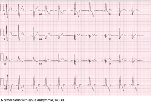 Figure 1 EKG initial presentation.