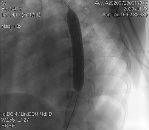 Figure 5 The second 12×59 mm cover stent at the proximal of the descending thoracic aorta.