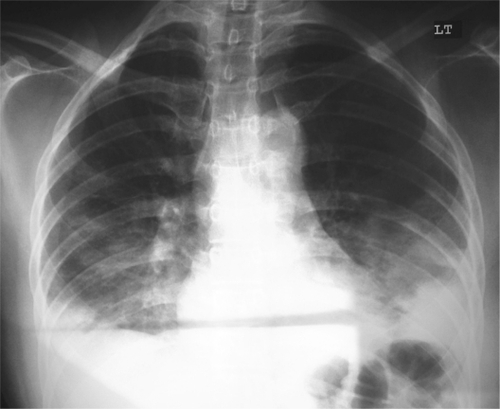 Figure 2 Chest X-ray showing bilateral patchy opacification.