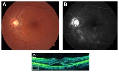 Figure 1 (A) Before bevacizumab treatment, the color fundus photograph shows optic disc swelling, peripapillary hemorrhage, retinal exudates and microangiopathy. (B) Fluorescein angiography demonstrates optic disc and macular edema, capillary nonperfusion, and microaneurysms. (C) Optical coherence tomography (OCT) reveals serous retinal detachment.