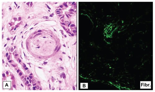 Figure 2 (A) Moderate interstitial edema with mild inflammatory cell infiltration and patched tubular atrophy with (B) fibrinogen deposits in the arterial wall in the immunofluorescence study.