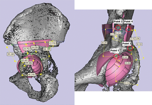 Figure 3. The most important and easily identifiable bony landmark was point 1, which was the intersection point between the acetabular rim and the anterior inferior iliac spine. Other points and measurements were all based on point 1. Point 3 and other points at the acetabular rim were arbitrary. The custom pelvic prosthesis was designed in such a way that orientation of the superior surface of the prosthesis is parallel to the ground when the patient is in a standing position. When a person stands upright, the plane formed by the two anterior superior iliac spines and pubic tubercles is perpendicular to the ground. Therefore, orientation of the prosthesis and bony resection could be defined and planned using this plane. Based on points 2 and 4 and the above information, the plane and level of bony resection could be defined with points 1–4 in the navigation planning. Other points and distances were used to verify the accuracy of this plane definition. [Color version available online.]