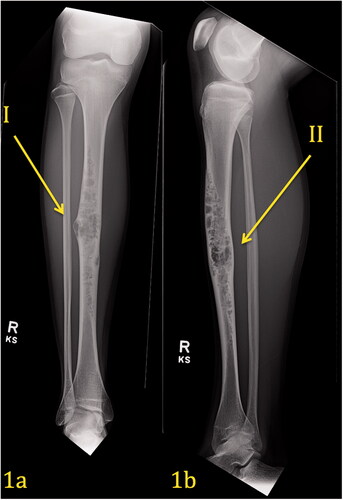 Figure 1. (a,b) Pre-operative Imaging Right Tibia. AP view (1a) of the right leg demonstrates an expansile, multilocular, lytic lesion with ‘soap bubble’ appearance and narrow zone of transition within the diaphysis of the tibia affecting the cortex and medullary canal. There is associated cortical remodeling and endosteal thinning. No cortical breakthrough is present and only a slight benign-appearing periosteal reaction is present (Arrow I). Lateral view (1b) of the right leg corroborates the findings on the frontal projection.