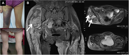 Figure 1 (A): The patient’s right buttock and left thigh was obviously enlarged. There was ecchymosis over left thigh (above). The ecchymosis disappeared after 3 months (below). (B): T2 weighted imaging of magnetic resonance imaging showed occupying lesion (probably hematoma, see white arrows) deep under the right gluteus maximus, and the signal of muscles and other soft tissues around the pelvis and femur increased widely.