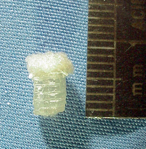 Figure 1. Double-layer bioimplant for the treatment of osteochondral defects.