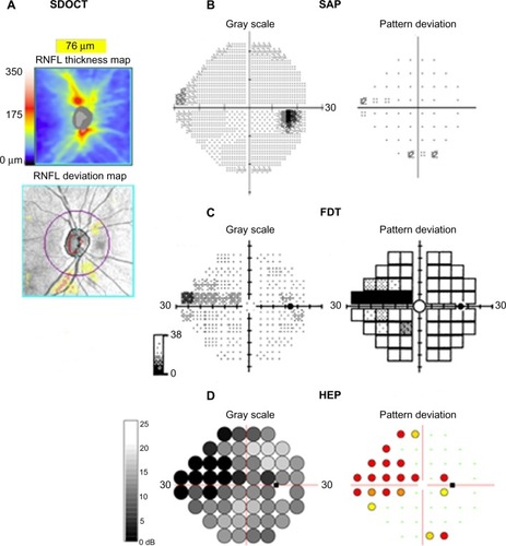 Figure 2 (A–D) Perimetric test results using three devices for the right eye of a subject with glaucoma. Spectral domain optical coherence tomography (SDOCT) shows inferior retinal nerve fiber layer thinning (A). Standard automated perimetry (SAP) shows a possible early superonasal defect (B), which is confirmed on frequency-doubling technology (FDT) perimetry (C) and with the flicker-defined form Heidelberg edge perimeter (HEP) (D).