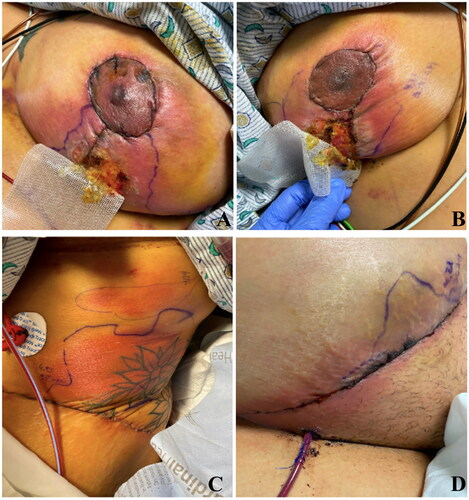 Figure 1. One-week post breast reduction and abdominoplasty: Patient presented with tender pink-red firm patches and nodules, swelling of the skin around the incision sites, wound dehiscence, with overlying crust. A: Right breast incision site B: Left breast incision site C: Abdominal incision site D: Left lateral abdomen incision site.