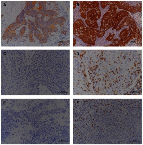 Figure 1 Representative images of immunohistochemical staining of SNSCC tissue: (A) PD-L1-positive (100×); (B) p16-positive (100×); (C) low CD8 infiltration (400×); (D) high CD8 infiltration (400×); (E) low Foxp3 infiltration (400×); (F) high Foxp3 infiltration (400×). Abbreviations: SNSCC, sinonasal squamous cell carcinoma; PD-L1, programmed death-ligand 1.