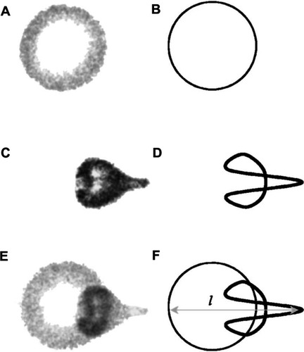 Figure 7 Still images from a high speed video of a microbubble undergoing asymmetric collapse during inertial cavitation creating a fluid jet. (A) The original microbubble before ultrasound exposure. (B) A schematic of the microbubble outline before ultrasound exposure. (C) The microbubble during ultrasound exposure, undergoing an asymmetric collapse where the left side actually collapsed through the airspace of the microbubble and penetrated through the right side. (D) Schematic showing the microbubble outline during collapse. (E) Overlaid images of the microbubble before ultrasound exposure and during collapse. (F) Schematic of the before and during ultrasound exposure outlines of the microbubble.Reproduced from Postema et al.Citation61