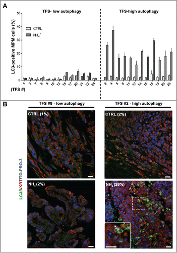 Figure 4. In tumor fragment spheroids, LC3 immunofluorescence indicates low or high levels of autophagy. TFS were generated from tumor biopsies obtained from 25 chemonaive MPM patients and grown in the presence or absence of ammonium chloride (NH4+) for 12 h. TFS were then fixed, embedded in paraffin, stained for LC3B (green), KRT/cytokeratin to identify mesothelioma cells (red), and nuclei (blue), and imaged by confocal microscopy. (A) Bars represent the mean percentage of LC3-positive MPM cells measured in TFS grown in the presence (gray bars) or absence (white bars) of NH4+. Error bars, SEM (B) Representative images of TFS with either low (TFS #8) or high (TFS #2) autophagy levels are shown, with the percentage of mesothelioma cells with LC3 puncta (LC3-positive MPM cells) indicated in parentheses. Zoom-in view of the region in the dashed box shows representative cells with LC3 puncta (arrowhead). Scale bars: 10 µm.