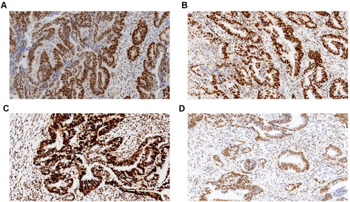 Figure 2 Representative immunohistochemical staining data (x200). Mismatch repair proteins in sporadic colorectal cancer tissue samples were found in the cell nucleus. (A) Positive MLH1 signals; (B) positive MSH2 signals; (C) positive MSH6 signals; (D) positive PMS2 signals.