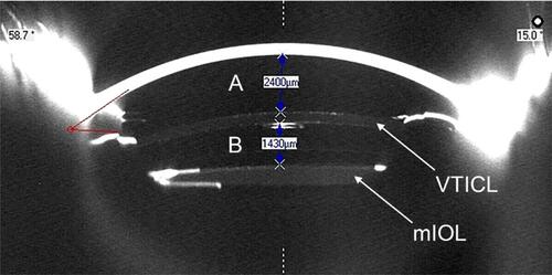 Figure 3 Scheimpflug image (Pentacam® HR, Oculus) from a patient at the 90–270° meridian 3 months after VTICL implantation: (A) distance between endothelium and VTICL: 2400 µm and (B) vault between VTICL and mIOL: 1430 µm.Abbreviations: mIOL, multifocal intraocular lens; VTICL, Visian Toric Implantable Collamer Lens®.