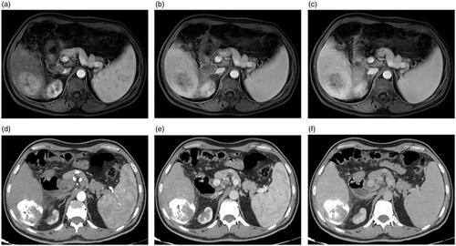 Figure 5. A 65-year-old man with a history of antiviral treatment for hepatitis C virus. Contrast-enhanced MRI before treatment: (a) arterial, (b) portal, and (c) delayed phases show a single 4.9-cm focal lesion at segment VI with HCC criteria (arterial enhancement and delayed washout). The patient underwent TACE and then MWA after two weeks. Follow up contrast-enhanced CT 24 months after the procedure: (d) arterial, (e) portal, and (f) delayed phases show complete response. The effect of MWA is seen in the center of the lesion, and the effect of TACE is seen in the lesion periphery.