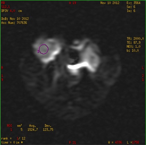 Figure 3 ROI was drawn on the b0 image with a homogenous area of tumor, consistent with minimal contamination from unintended tissues; moreover, signal intensities were measured for each b value with a copy–paste operation.