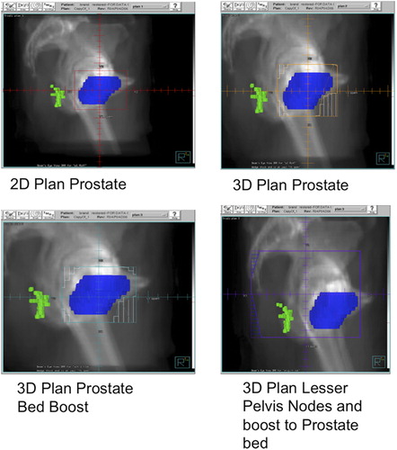 Figure 3. Relationship of the pudendal nerve (in green) with the target volumes (in blue) encompassed by the digitally reconstructed radiograph of the right lateral field corresponding to the simulated 2D (top left) and simulated 3D (top right) plans and actual 3D plan of the patient treated to the lesser pelvic nodes (bottom right) with a boost to the prostate bed (bottom left).