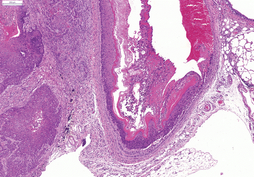 Figure 7.  Invading squamous cell carcinoma after repeated intratracheal instillation of ultrafine carbon black (PRINTEX® 90). H&E × 10.