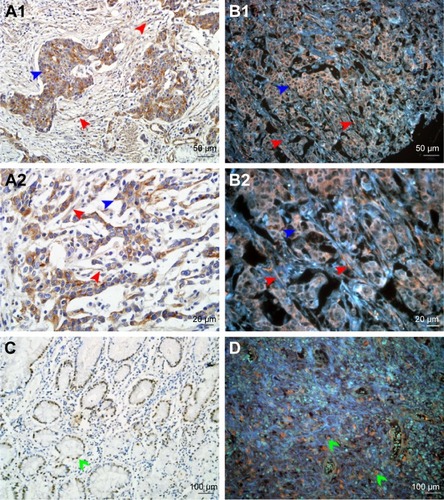 Figure 1 Expression of LOX in GC.Notes: (A1 and A2) LOX expressed in cytoplasm of cancer cells (blue arrows) and stromal cells (red arrows) revealed by IHC. (B1 and B2) LOX was stained orange and expressed in cytoplasm of cancer cells (blue arrows) and stromal cells (red arrows) revealed by QDs-585-conjugated antibody nanoprobe. (C) LOX expressed in nucleus of cancer cells (green arrows) revealed by IHC. (D) LOX expressed in nucleus of tumor cells (green arrows) revealed by QDs-585 probe-based single molecular imaging. Magnification: 200× (A1, B1, C and D), 400× (A2 and B2), 100× (C and D). Scale bar: 50 μm for (A1 and B1), 20 μm for (A2 and B2) and 100 μm for (C and D).Abbreviations: LOX, lysyl oxidase; GC, gastric cancer; IHC, immunohistochemistry; QD, quantum dot.