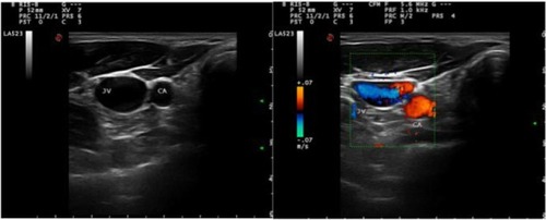 Figure 5 Ultrasound cross-sectional (left) and Doppler ultrasound (right) image of right internal jugular vein (IJV) and carotid artery (CA).