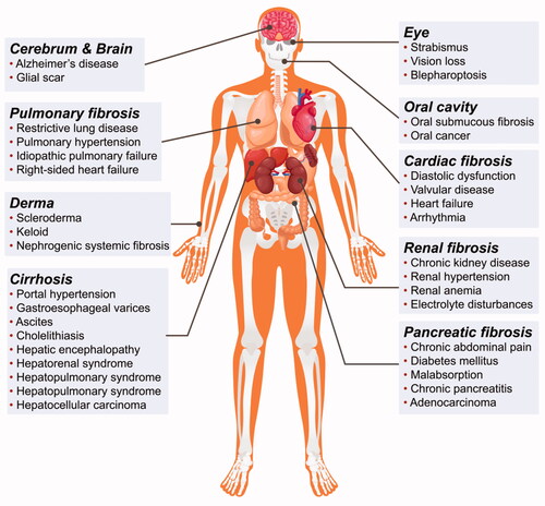 Figure 1. Distribution of fibroproliferative disorders in the human body. Nearly all organs and tissues can develop fibroproliferative disorders indicating the complexity and broadness of fibrotic diseases.