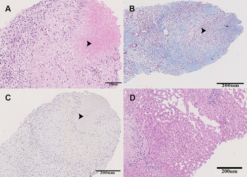 Figure 2 The histopathology of the liver specimen obtained from the biggest nodule. The black arrows indicated the granulomatous inflammation with central caseous necrosis. (A) Hematoxylin & eosin staining, (B) Masson triple staining, (C) acid-fast staining, and (D) Hematoxylin & eosin staining of the para-nodule liver specimen.