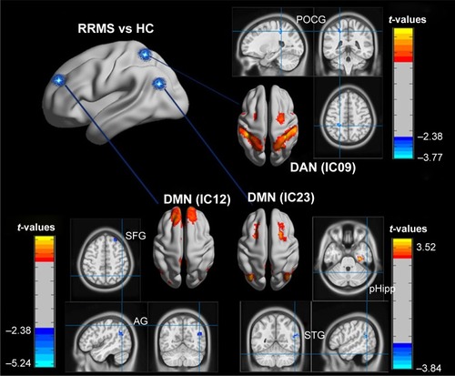 Figure 2 Compared with the HCs, significantly altered FC was observed in the remitting-phase RRMS patients (two-tailed voxel-level, p < 0.01; cluster-level, p < 0.05; GRF corrected).