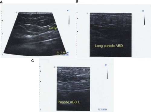 Figure 1 Ultrasonography of one of the participants, the first taken before cryolipolysis (A) and the following taken 30 (B) and 60 days (C) later.