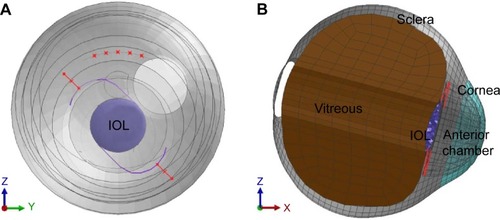 Figure 1 Frontal view of the model eye with transsclerally fixated PC IOL.