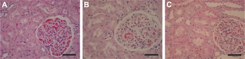 Figure 6 Results of histopathological analysis of the kidney. (A) NC – preserved glomerulus, unaltered proximal and distal tubules, and glomerular and interstitial hemorrhage. (B) LDE-PTX175 – preserved glomerulus, unaltered proximal and distal tubules, and glomerular and interstitial hemorrhage. (C) LDE-PTX250 – preserved glomerulus, proximal and distal tubes with cellular tumefaction, and glomerular and interstitial hemorrhage, several exhibiting cylinder hyaline. Magnification is 400×, and scale bar represents 50 μm.Abbreviations: NC, negative control; LDE, cholesterol-rich nanoemulsion; PTX, paclitaxel.