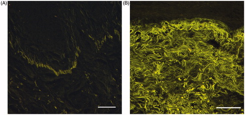 Figure 2. Autofluorescent elastin fibers under the basal membrane in the vaginal wall in healthy women (A), and thick aggregated elastin fibers scattered throughout the connective tissue in the cervical cancer survivors (B). Scale bar = 200 μm.