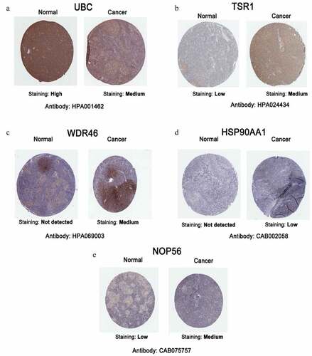 Figure 5. Representative immunohistochemistry images of hub genes in DLBCL and noncancerous lymphoma tissues derived from the HPA database. (a) UBC; (b) TSR1; (c) WDR46; (d) HSP90AA1; and (e) NOP56.