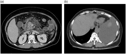 Figure 4. Severe necrotizing pancreatitis (combined pancreatic and peripancreatic) in a 42-year-old male (CRP level of 253 mg/L, Ranson, BISAP, Marshall, APACHE II, CTSI, and EPIC of 5, 4, 18, 6, 6, and 3 points, respectively; positive for infection and organ failure while no procedure was done, no ICU admission, or death on this patient). Abdominal axial contrast-enhanced CT at the portal phase (A) showed there was a large amount of acute necrotic collection (ANC) around the pancreas. Axial chest image CT (B) showed there was a large amount of left pleural effusion.