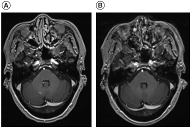 Figure 2. Brain MRIs of first relapse of primary central nervous system lymphoma and its resolution after temozolomide+rituximab treatment. (A) Brain MRI showed first relapse at 11 months after completion of high dose-methotrexate (HD-MTX) induction therapy, 17 months after diagnosis of primary central nervous system lymphoma. The recurrent lymphoma was seen at right cerebellum on the post-contrast T1 image. (B) Brain MRI showed resolution of 1st relapsed lymphoma on the post-contrast T1 image at right cerebellum after 1 cycle (4 weeks) of temozolomide (TMZ) and rituximab (RTX) therapy.
