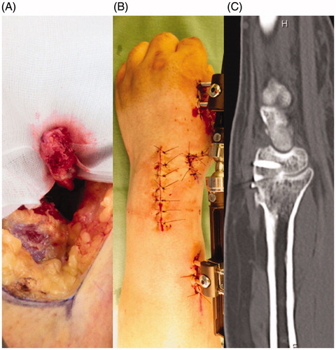 Figure 3. (A) Intraoperative photograph of the vascularized bone graft at the time of harvesting. (B) Immediately postoperative photograph of the wrist with the external fixation device. (C) At 3 months after the last surgery, a radiograph confirmed bony union.