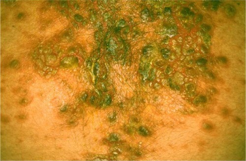 Figure 1 Crusted lesions involving seborrheic areas of the chest.