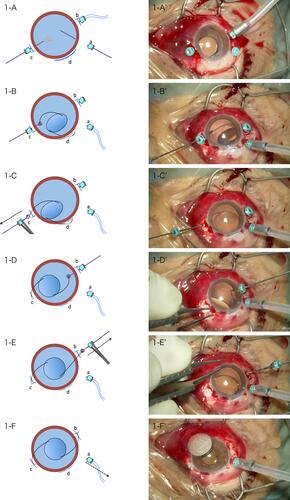 Figure 1 Port-fixation group. Representative case, right eye. (A)Supranasal (c) and inferotemporal (b) trocars (25-gauge) were placed in the center of a T-shaped lamellar scleral incision 2 mm from the corneal limbus and a supratemporal trocar (a) was placed 3.5 mm from that. (B, C) Following a vitrectomy, the infusion cannula was changed from an inferotemporal to supratemporal trocar. At the time when the IOL was halfway inserted into the eye (d), the first IOL haptic and a supranasal trocar were simultaneously withdrawn through the sclera by grasping with 25-gauge vitreoretinal forceps. (D, E) The second IOL haptic and an inferotemporal trocar were simultaneously withdrawn through the sclera by grasping with 25-gauge vitreoretinal forceps. (F) Both tips of the IOL haptics were embedded into preliminary intrascleral spaces and the infusion cannula was finally removed.