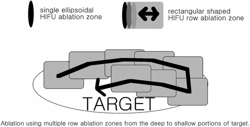 Figure 2. Targets were ablated using mostly multiple HIFU row ablation zones with single ellipsoidal HIFU ablation zones when necessary. Deep portions were targeted first with shallower areas targeted subsequently.