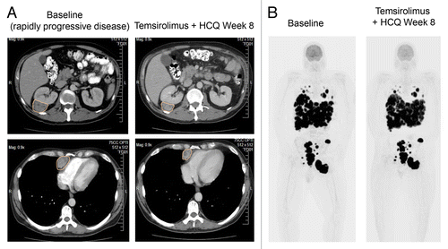 Figure 1. Antitumor activity of temsirolimus and hydroxychloroquine. (A) Serial contrast CT (CT) scans of the chest and abdomen in a patient with rapidly progressive melanoma treated with temsirolimus and HCQ. Orange outlines: tumor. (B) Serial [18]-fluordeoxy glucose positron emission tomography (FDG-PET) scans of a melanoma patient with massive tumor burden at baseline, who was able to maintain performance status by achieving stable disease on temsirolimus and hydroxychloroquine. Black signal indicates FDG-avid tumor.