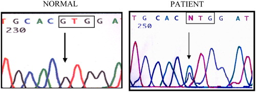 Figure 2. DNA sequencing electropherogram of the proband showing the Hb Koln mutation [β98 (FG5) [GTG → ATG, Val → Met]. The arrow indicates the position of the nucleotide substitution GTG (valine) > ATG (methionine).