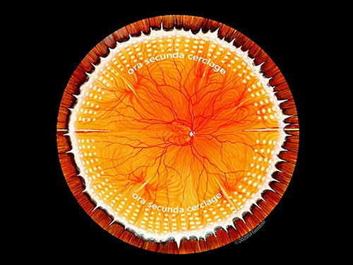 Figure 3 Illustration of our “standard” ora secunda cerclage (OSC) that has proven successful in non-syndromic eyes for more than two decades. Images ©(2020)Stephen F. Gordon.