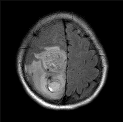 Figure 3 Female (25 years old) with headache and left lower limb weakness for two months. T2/fluid-attenuated inversion recovery showing internal hemorrhaging of the mass with a slightly higher signal intensity and obvious edema around it.