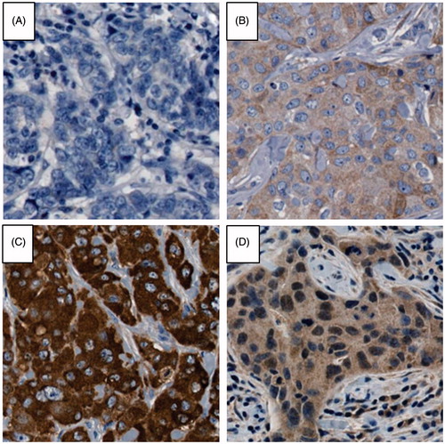Figure 1. Images of tumor cores representative of the categories used to classify Pak1 cytoplasmic staining intensity and nuclear positivity. A: negative cytoplasmic and negative nuclear staining; B: light cytoplasmic and negative nuclear staining; C: strong cytoplasmic and negative nuclear staining; D: light cytoplasmic and positive nuclear staining.