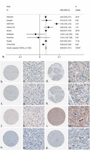 Figure 6. The expression of PRKCA in HCC. (a) An integrative analysis of PRKCA expression in HCC. (b-q) The immunohistochemistry profiles of PRKCA in HCC and normal liver tissue based on multiple antibodies. B-E): PRKCA stained in normal liver tissue and HCC by antibody HPA006563. B: ×40, C: ×400, D: ×40, E:×400. F-I): PRKCA stained in normal liver tissue and HCC by antibody HPA006564. F: ×40, G: ×400, H: ×40, I:×400. J-M): PRKCA stained in normal liver tissue and HCC by antibody CAB003844. J: ×40, K: ×400, L: ×40, M:×400. N-Q): PRKCA stained in normal liver tissue and HCC by antibody CAB016290