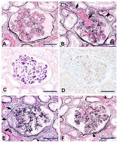 Figure 1 Renal pathology of DIC in association with metastatic prostate cancer. The peripheral glomerular capillaries (A) and afferent arteriole (B, arrows) were distended by thrombi formation (periodic acid methenamine silver stain). Fibrin strands revealed by phosphotungstic acid hematoxylin stain constituting the thrombi (C). The presence of sparsely scattered platelets within the thrombi was detected by immunostaining with an anti-CD41 antibody (D). Focal segmental sclerosis of the glomeruli (E and F; periodic acid methenamine silver stain). Segmental sclerosis of capillary architecture associated with attachments to the Bowman’s capsule with prominence of overlying epithelial cells (E, arrows). Segmental sclerosis was also noted at the urinary pole with capillary lumina obliterated by infiltration of mononuclear leukocytes and foam cells (F, arrowhead).